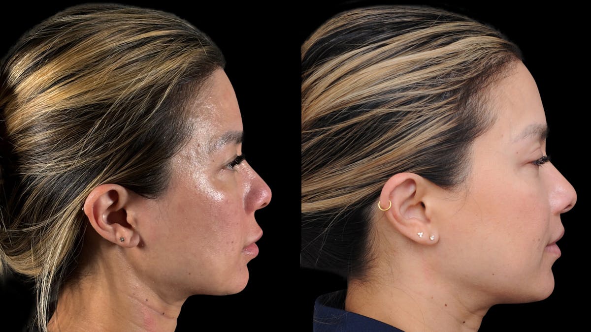 Lip Lift Before & After Gallery - Patient 301506 - Image 6