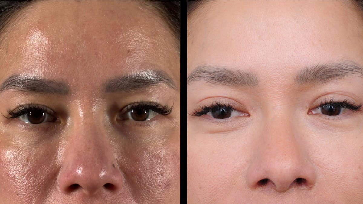 Lip Lift Before & After Gallery - Patient 301506 - Image 7