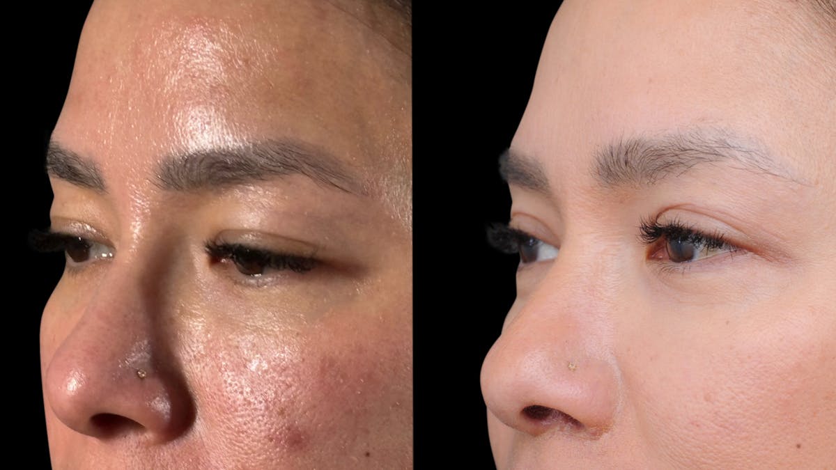 Lip Lift Before & After Gallery - Patient 301506 - Image 8