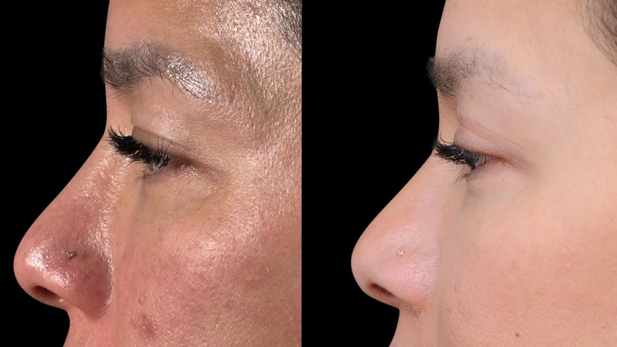 Lip Lift Before & After Gallery - Patient 301506 - Image 9