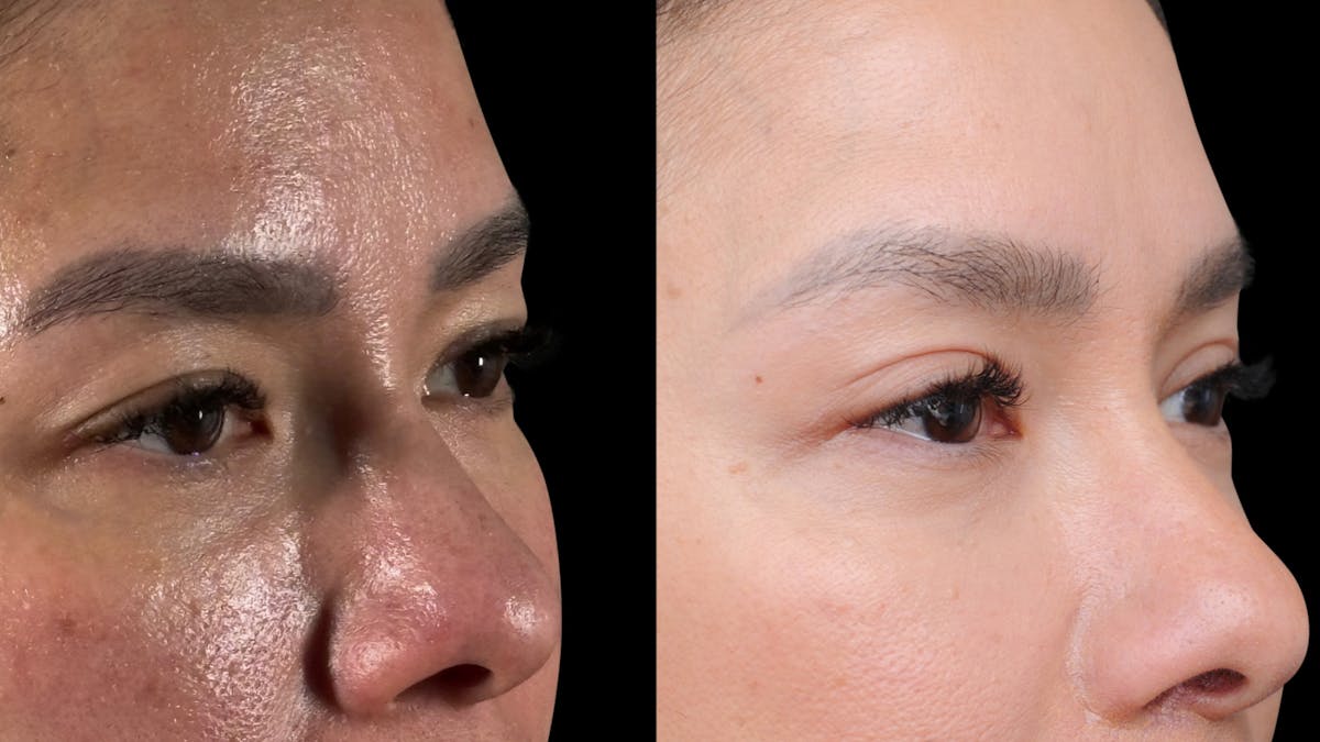 Lip Lift Before & After Gallery - Patient 301506 - Image 10