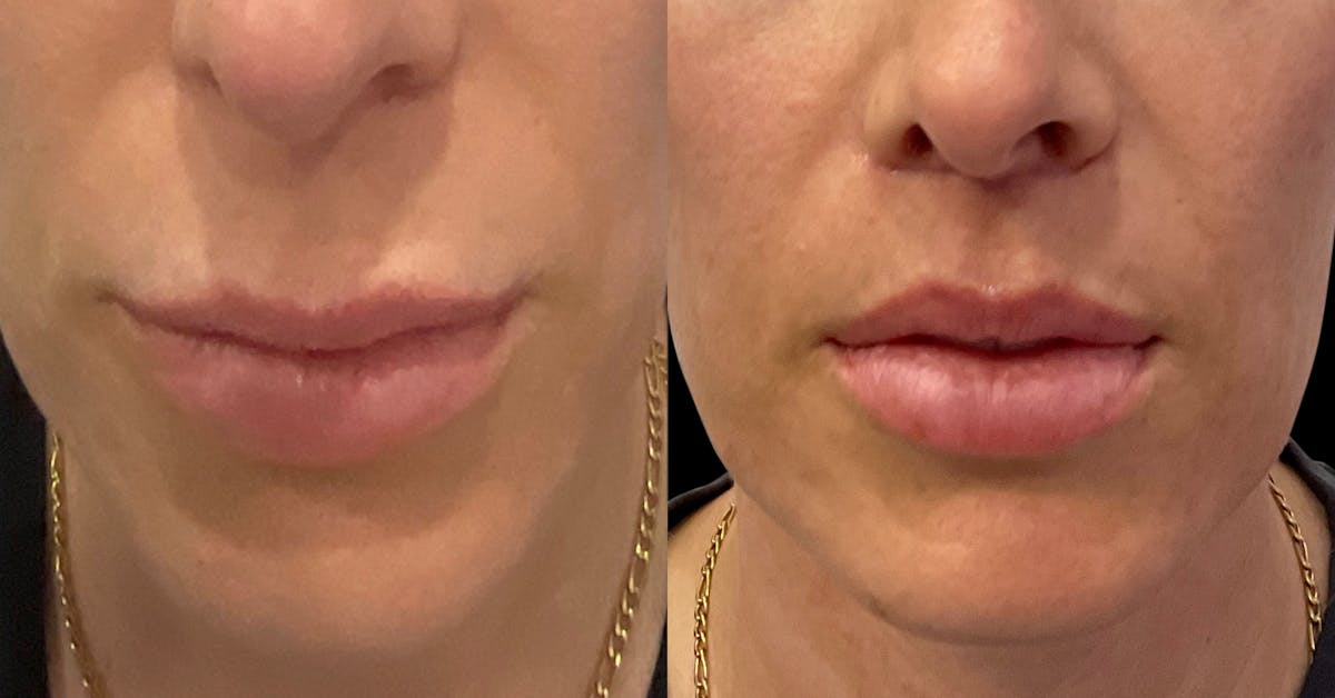 Lip Lift Before & After Gallery - Patient 246707 - Image 2