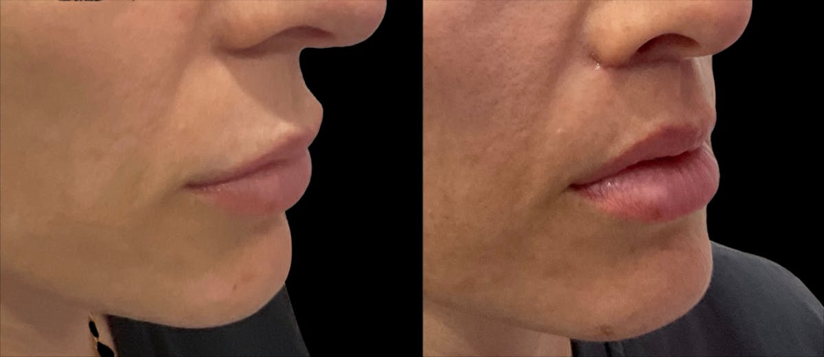 Lip Lift Before & After Gallery - Patient 246707 - Image 3