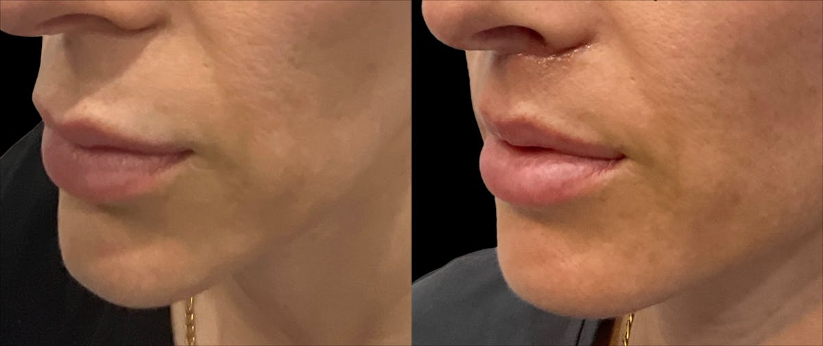 Lip Lift Before & After Gallery - Patient 246707 - Image 1