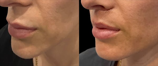 Lip Lift Before & After Gallery - Patient 246707 - Image 1