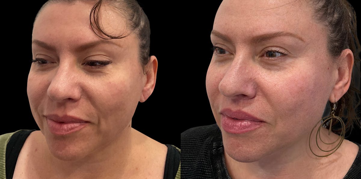 Lip Lift Before & After Gallery - Patient 259129 - Image 1