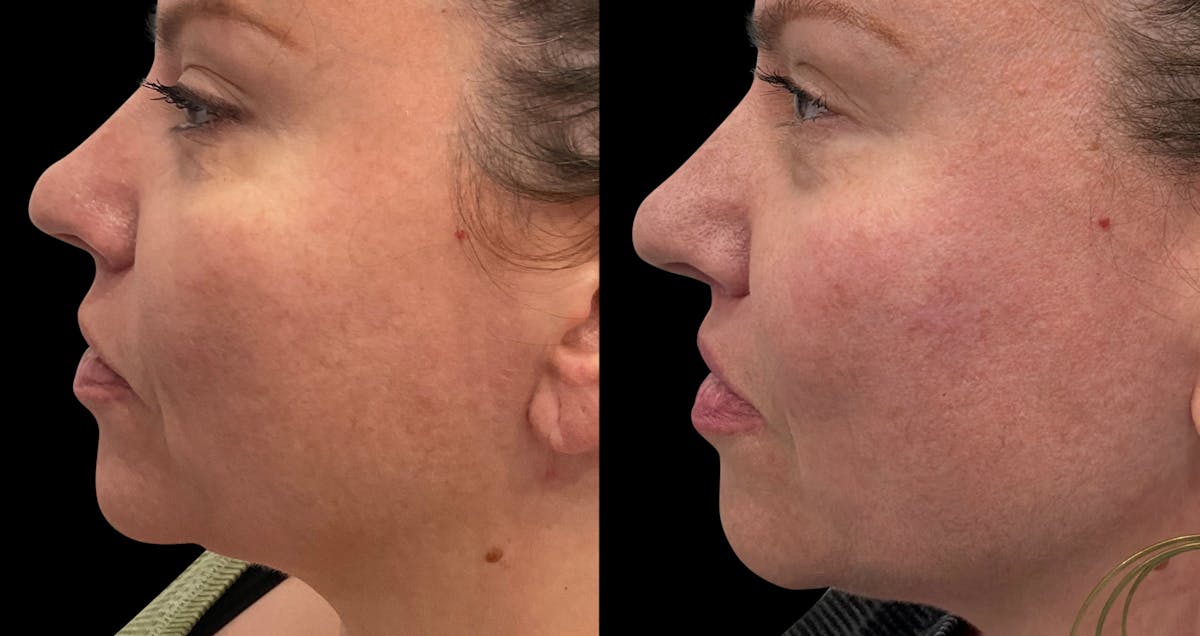 Lip Lift Before & After Gallery - Patient 259129 - Image 2
