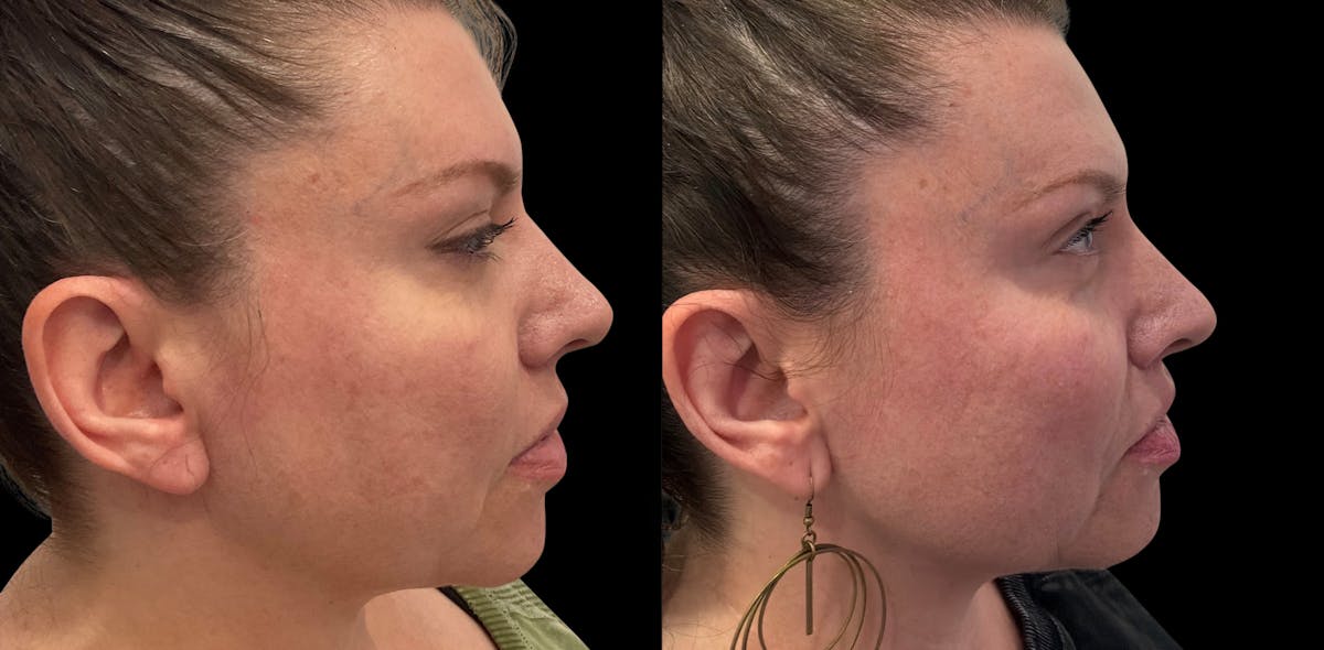Lip Lift Before & After Gallery - Patient 259129 - Image 3