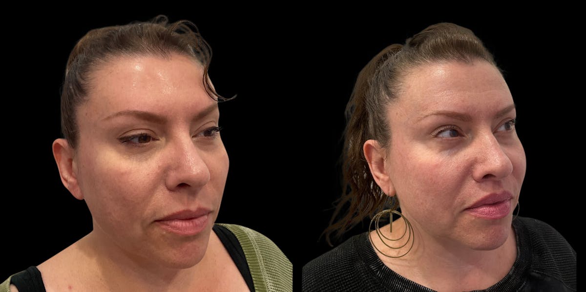 Lip Lift Before & After Gallery - Patient 259129 - Image 4