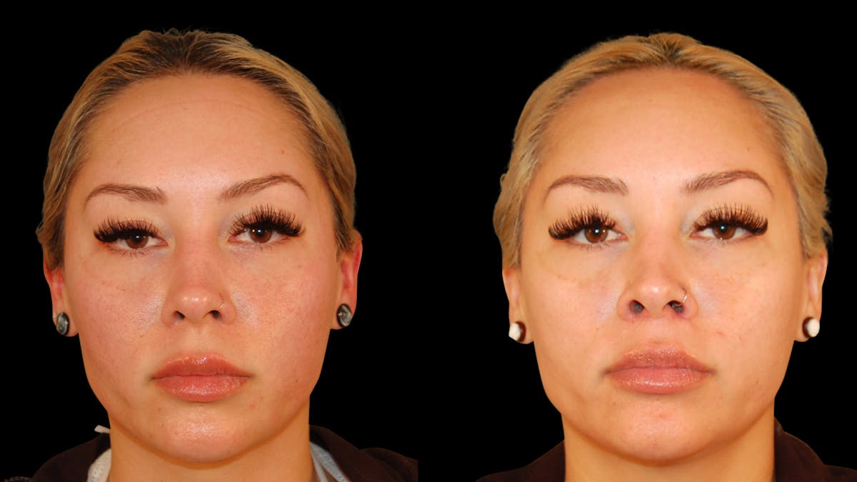 Lip Lift Before & After Gallery - Patient 306855 - Image 2