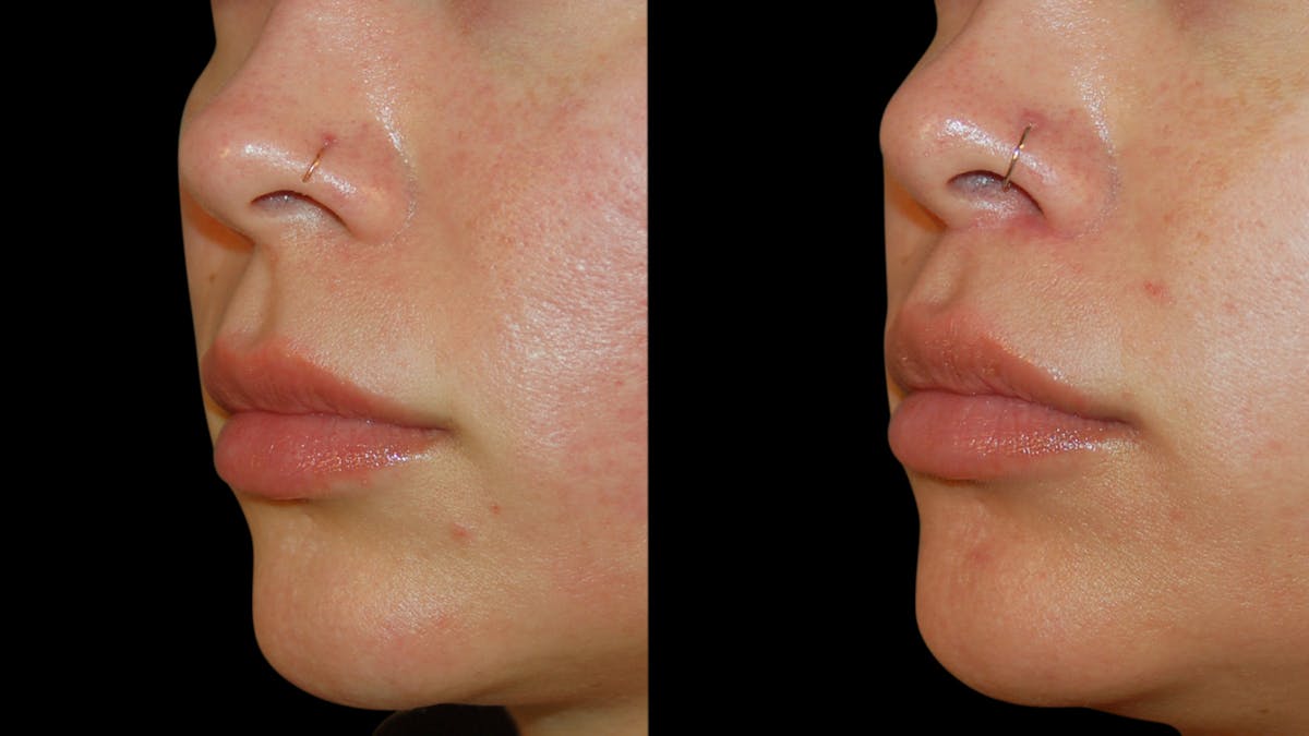 Lip Lift Before & After Gallery - Patient 306855 - Image 3