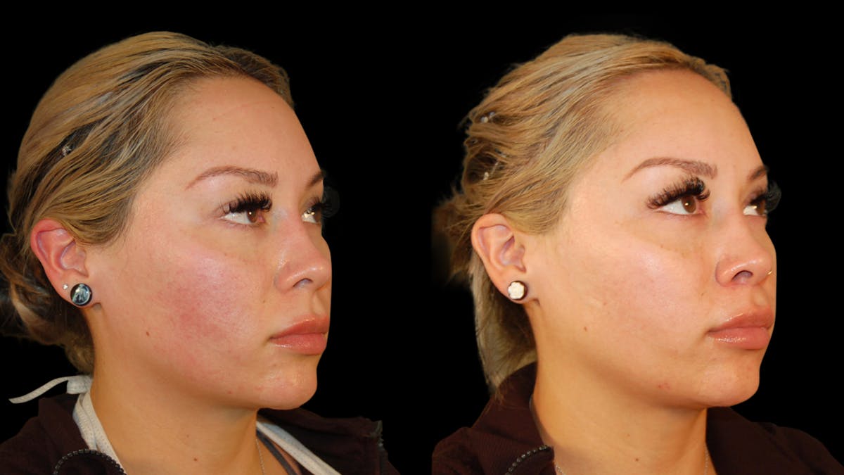 Lip Lift Before & After Gallery - Patient 306855 - Image 4