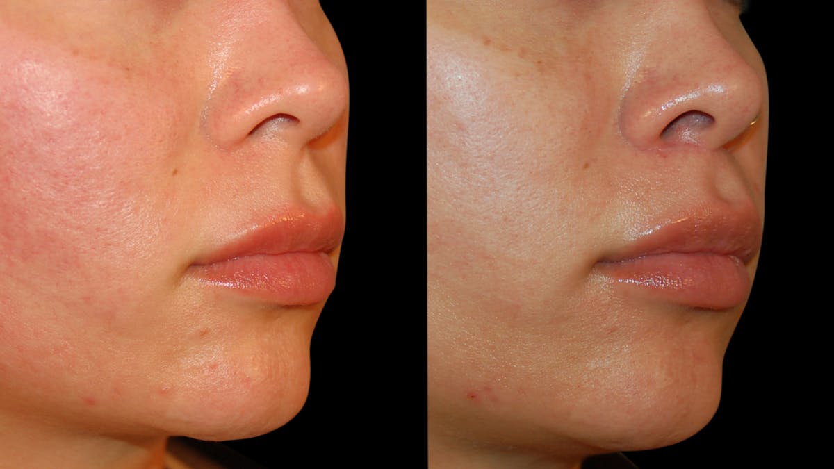Lip Lift Before & After Gallery - Patient 306855 - Image 5