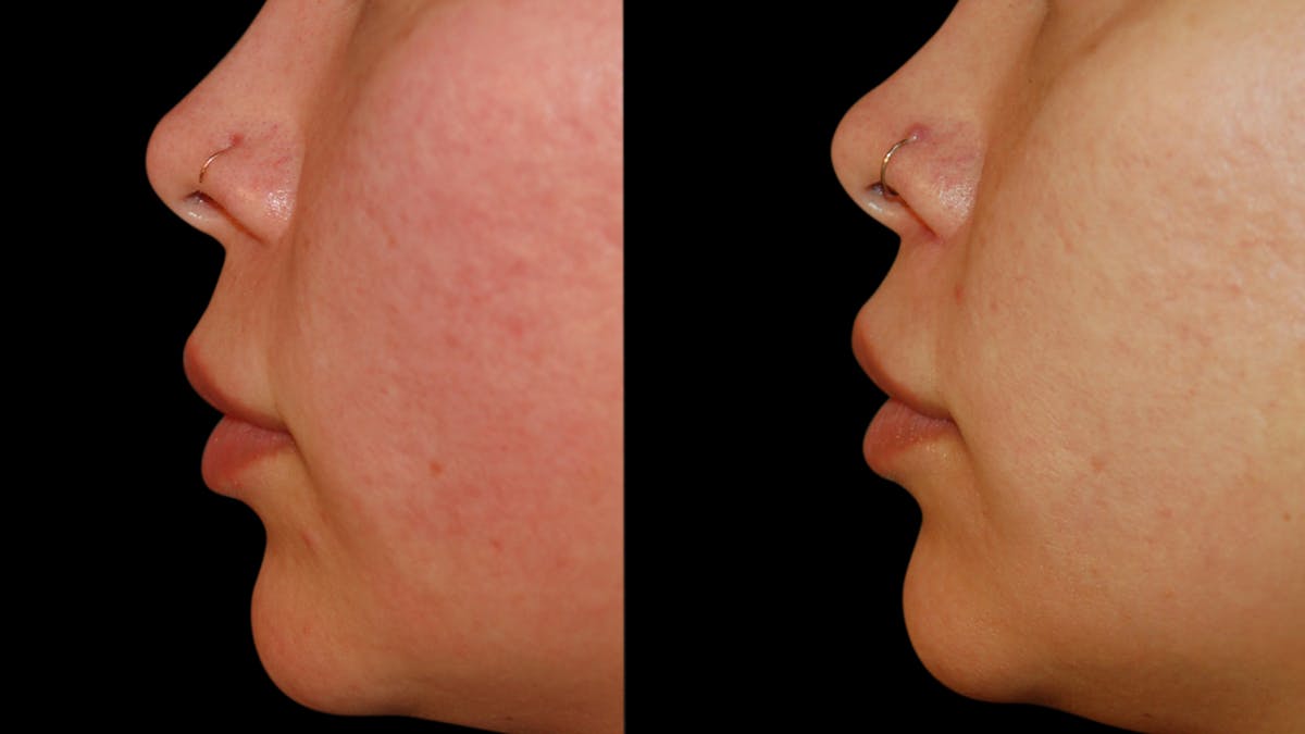 Lip Lift Before & After Gallery - Patient 306855 - Image 6