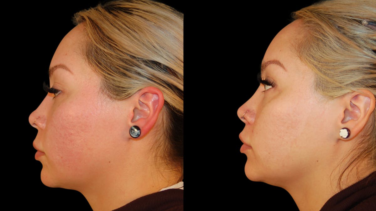 Lip Lift Before & After Gallery - Patient 306855 - Image 7