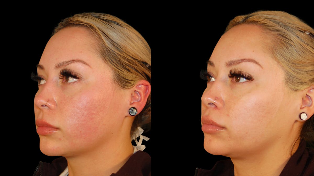 Lip Lift Before & After Gallery - Patient 306855 - Image 1