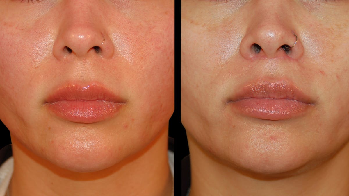 Lip Lift Before & After Gallery - Patient 306855 - Image 8