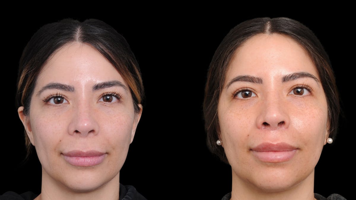 Lip Lift Before & After Gallery - Patient 220344 - Image 1