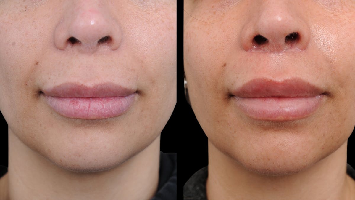 Lip Lift Before & After Gallery - Patient 220344 - Image 2