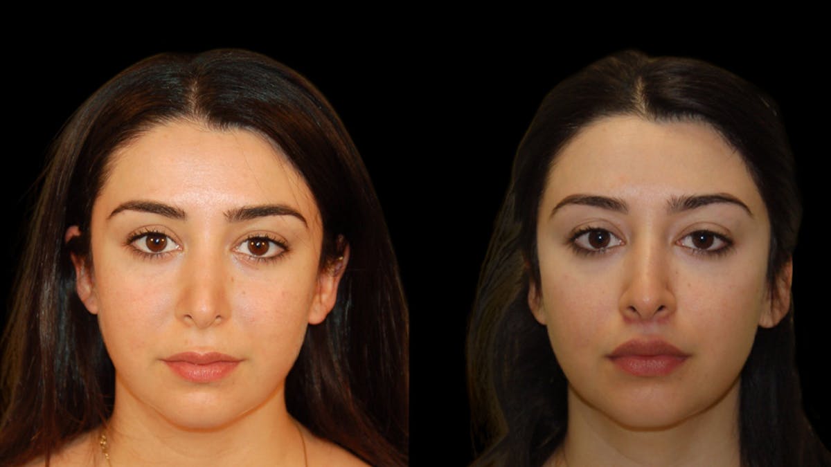 Lip Lift Before & After Gallery - Patient 248705 - Image 3
