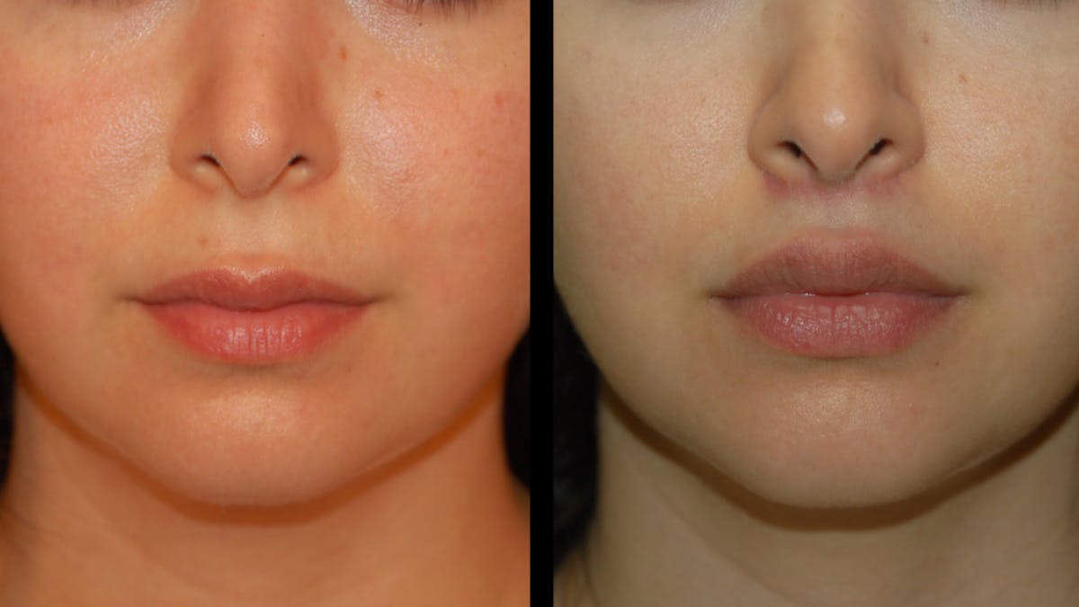 Lip Lift Before & After Gallery - Patient 248705 - Image 2