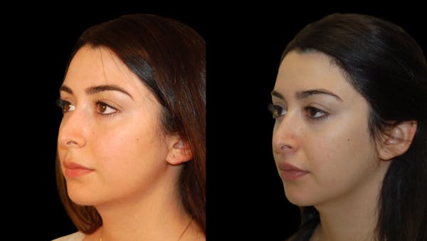 Lip Lift Before & After Gallery - Patient 248705 - Image 1