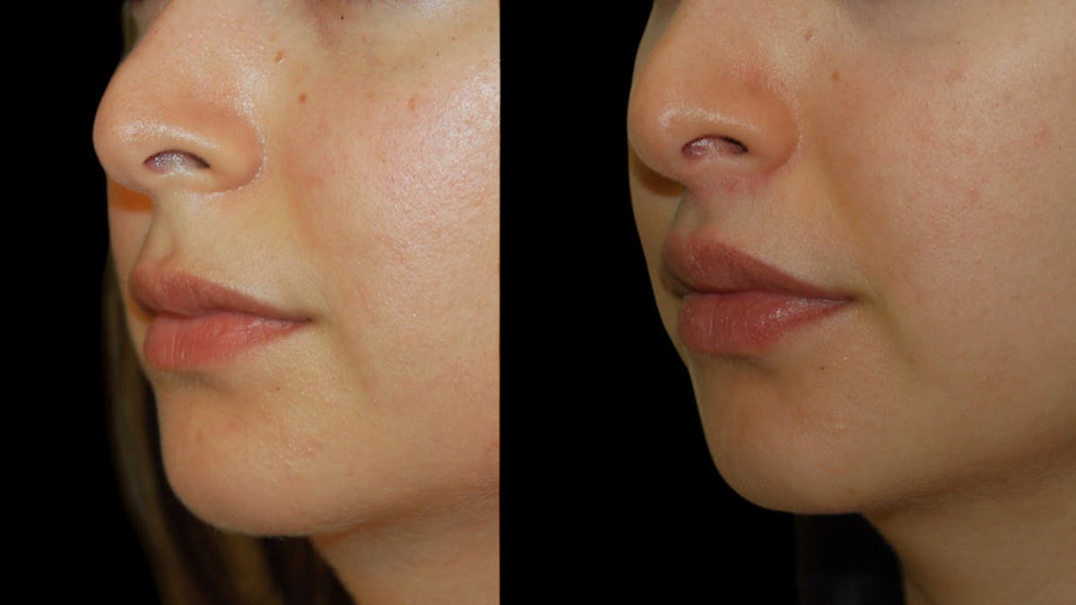 Lip Lift Before & After Gallery - Patient 248705 - Image 4