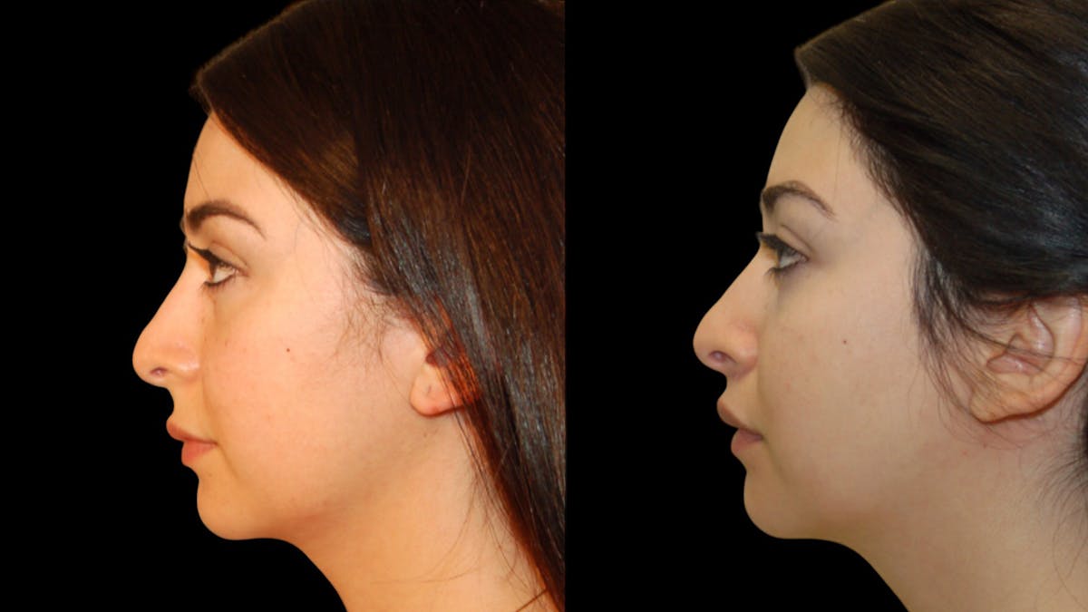 Lip Lift Before & After Gallery - Patient 248705 - Image 5