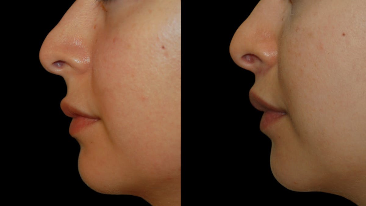Lip Lift Before & After Gallery - Patient 248705 - Image 6
