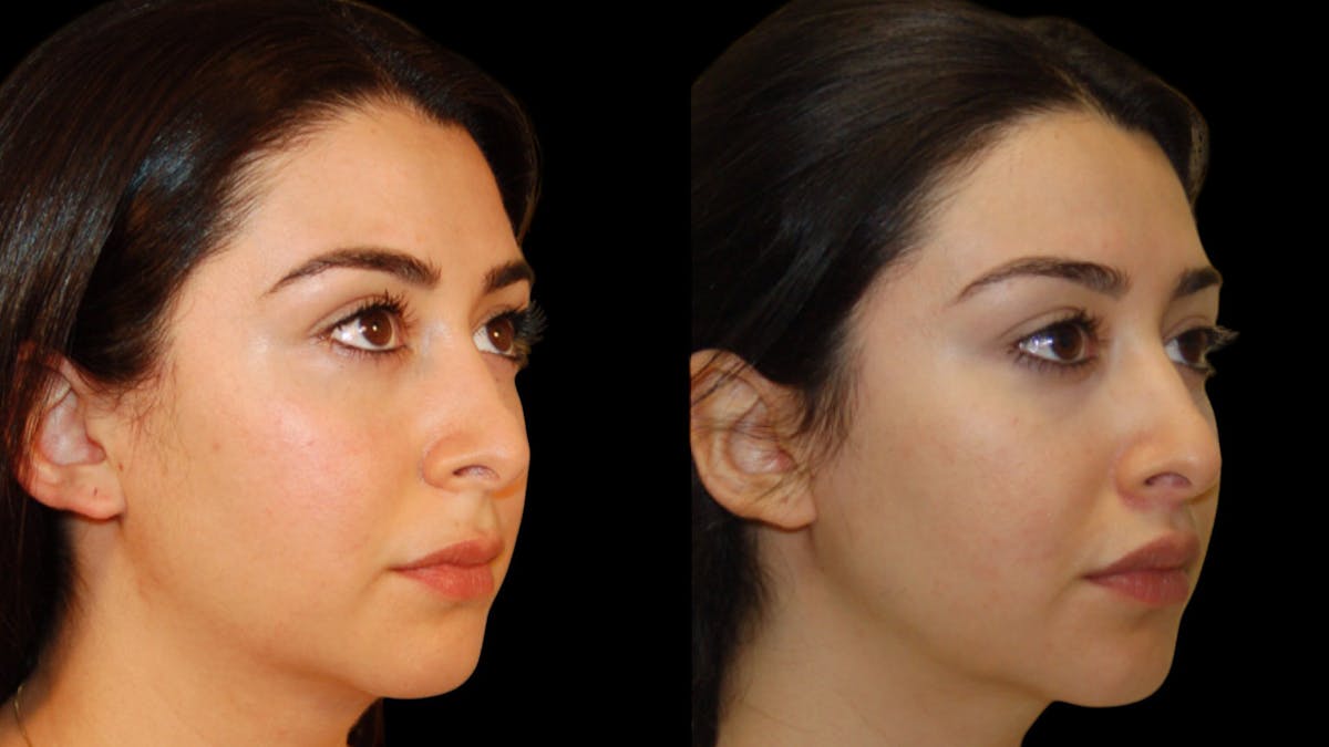 Lip Lift Before & After Gallery - Patient 248705 - Image 7