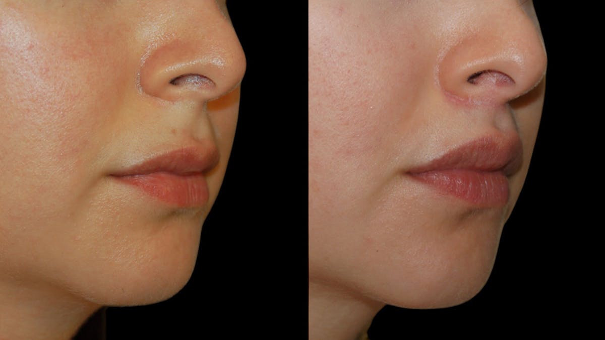 Lip Lift Before & After Gallery - Patient 248705 - Image 8