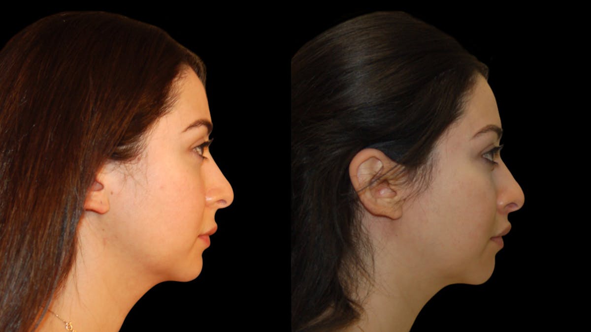 Lip Lift Before & After Gallery - Patient 248705 - Image 9