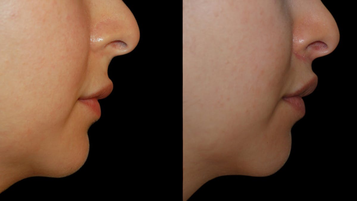 Lip Lift Before & After Gallery - Patient 248705 - Image 10