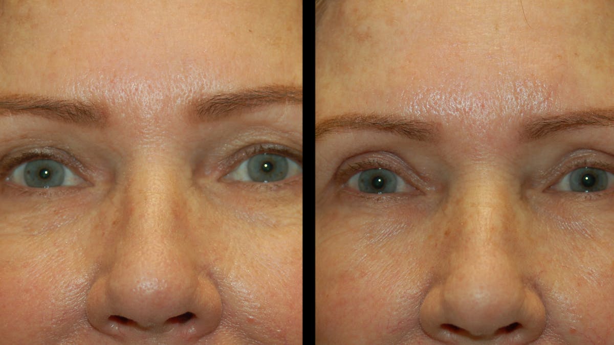 Lip Lift Before & After Gallery - Patient 544085 - Image 3