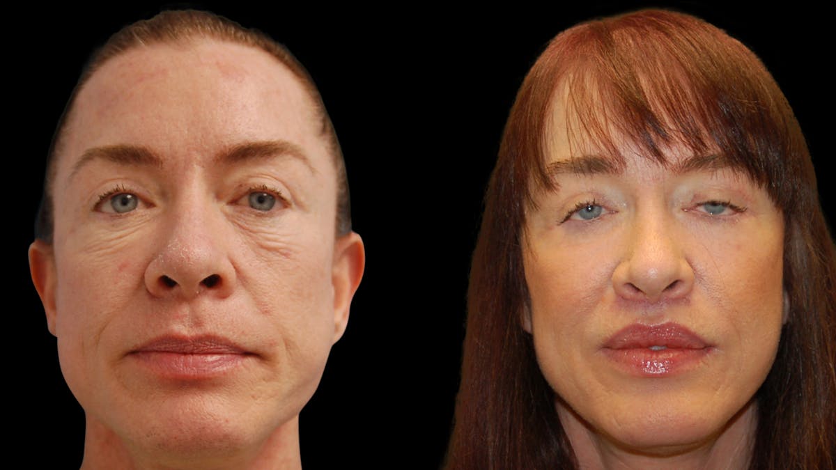 Lip Lift Before & After Gallery - Patient 544085 - Image 2