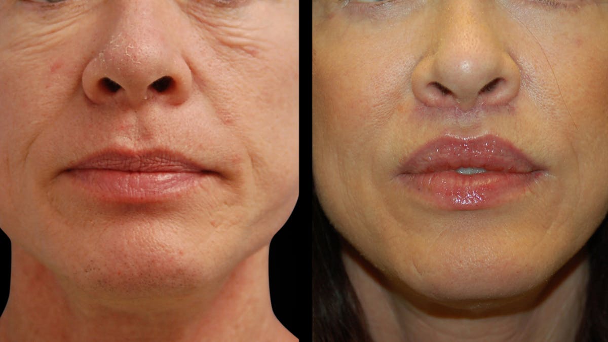 Lip Lift Before & After Gallery - Patient 544085 - Image 4