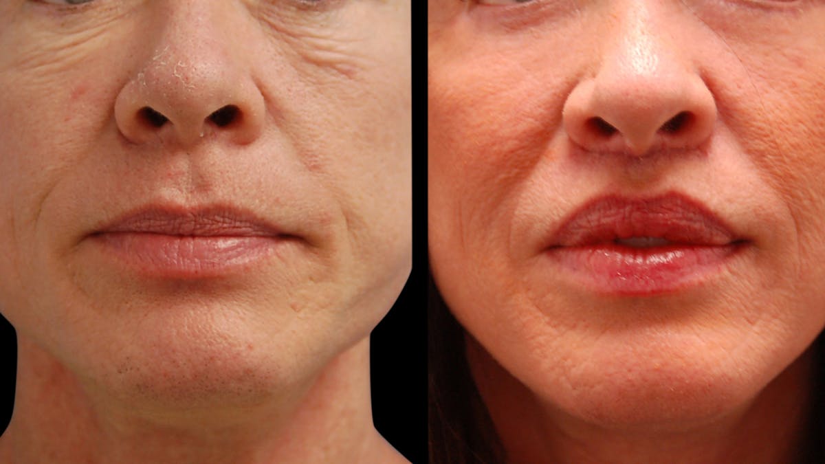 Lip Lift Before & After Gallery - Patient 544085 - Image 5
