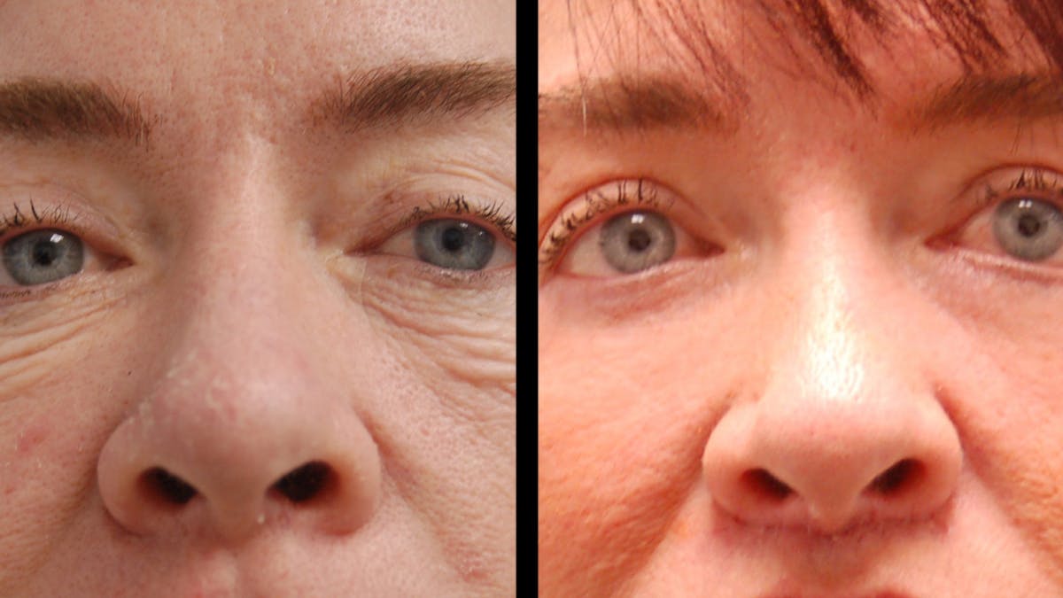 Lip Lift Before & After Gallery - Patient 544085 - Image 6