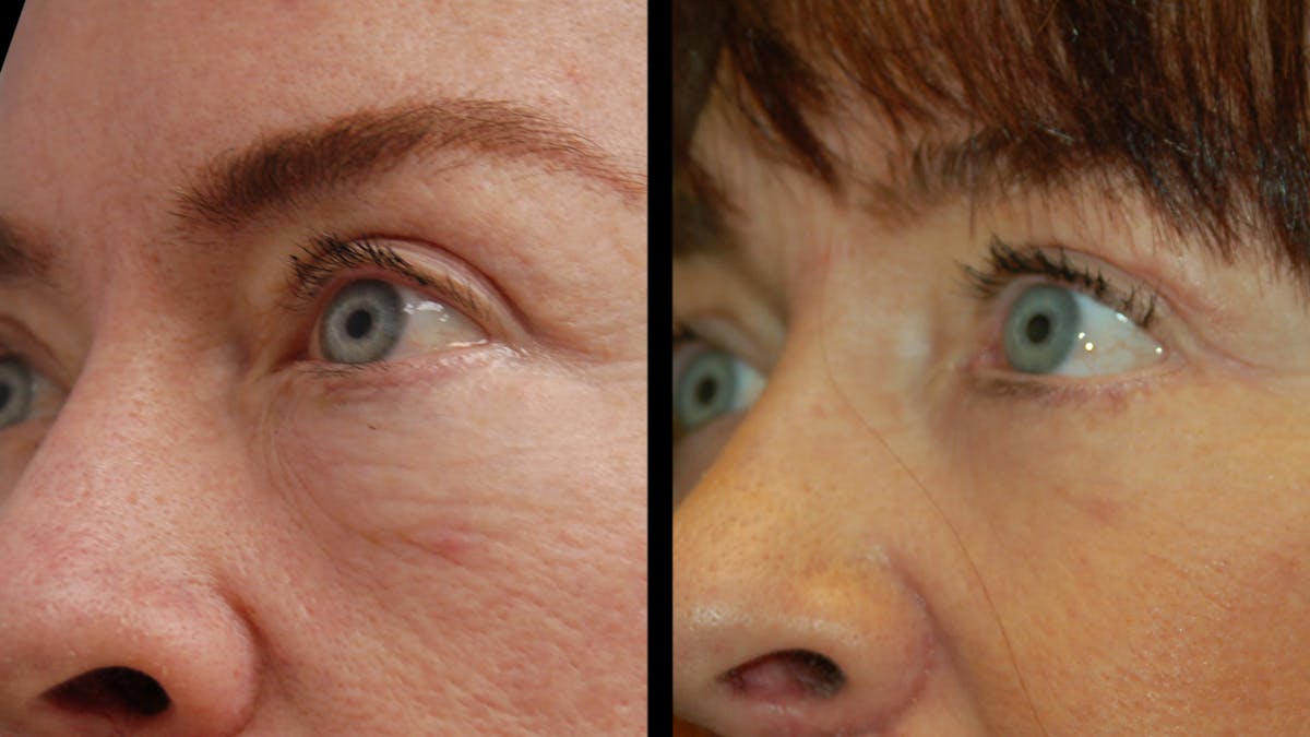 Lip Lift Before & After Gallery - Patient 544085 - Image 7