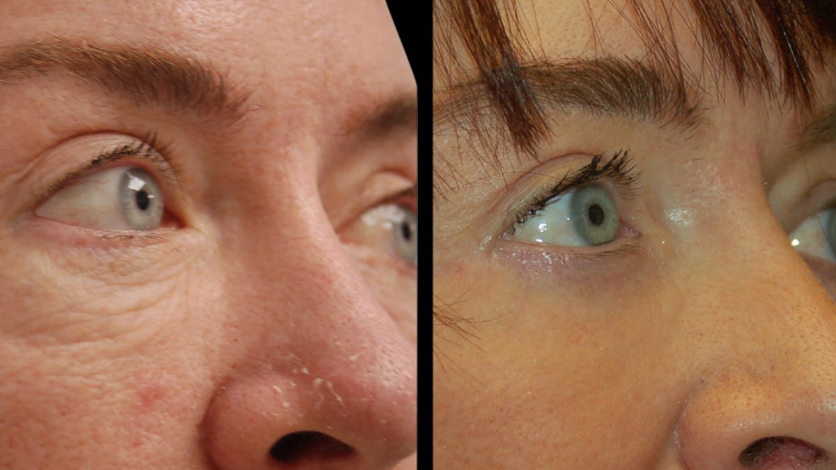 Lip Lift Before & After Gallery - Patient 544085 - Image 8
