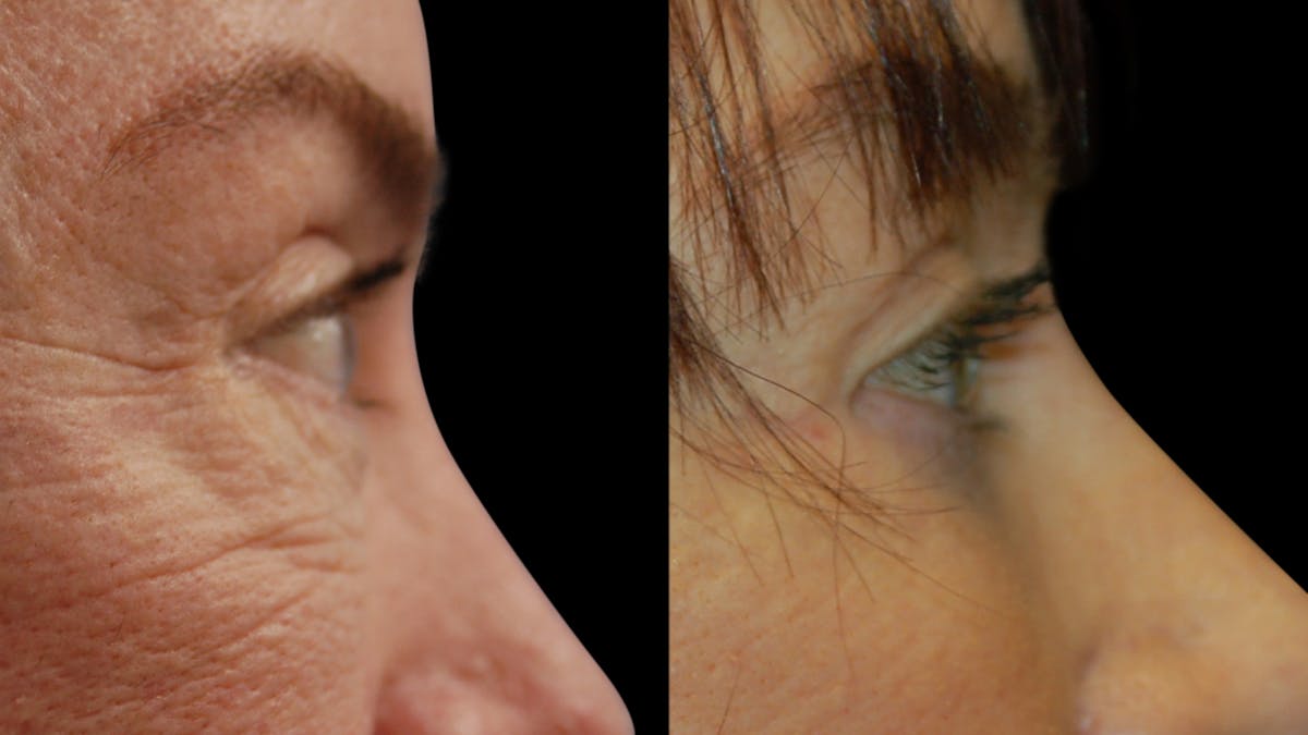 Lip Lift Before & After Gallery - Patient 544085 - Image 9