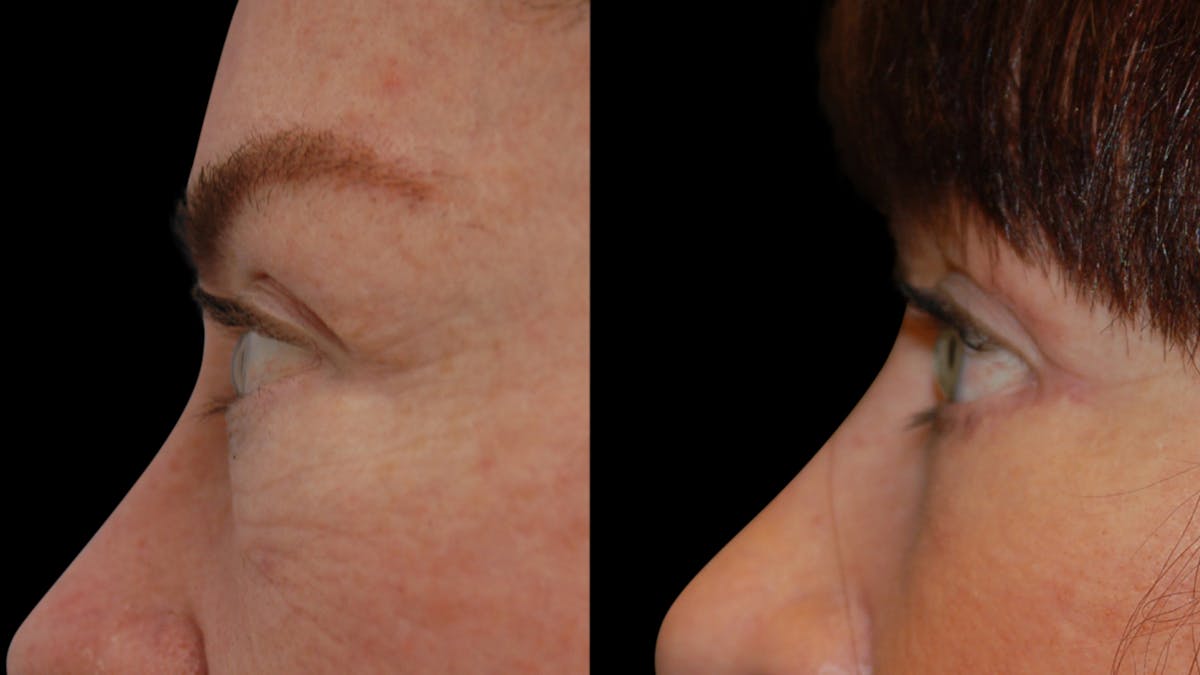 Lip Lift Before & After Gallery - Patient 544085 - Image 10