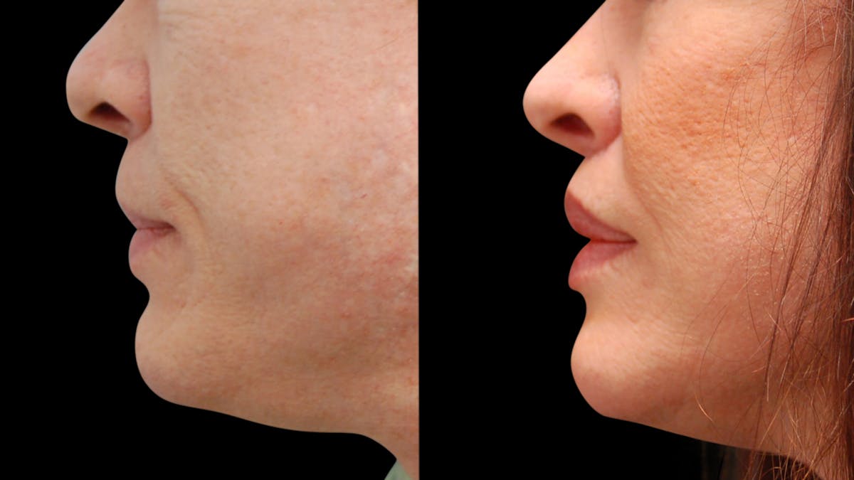 Lip Lift Before & After Gallery - Patient 544085 - Image 11