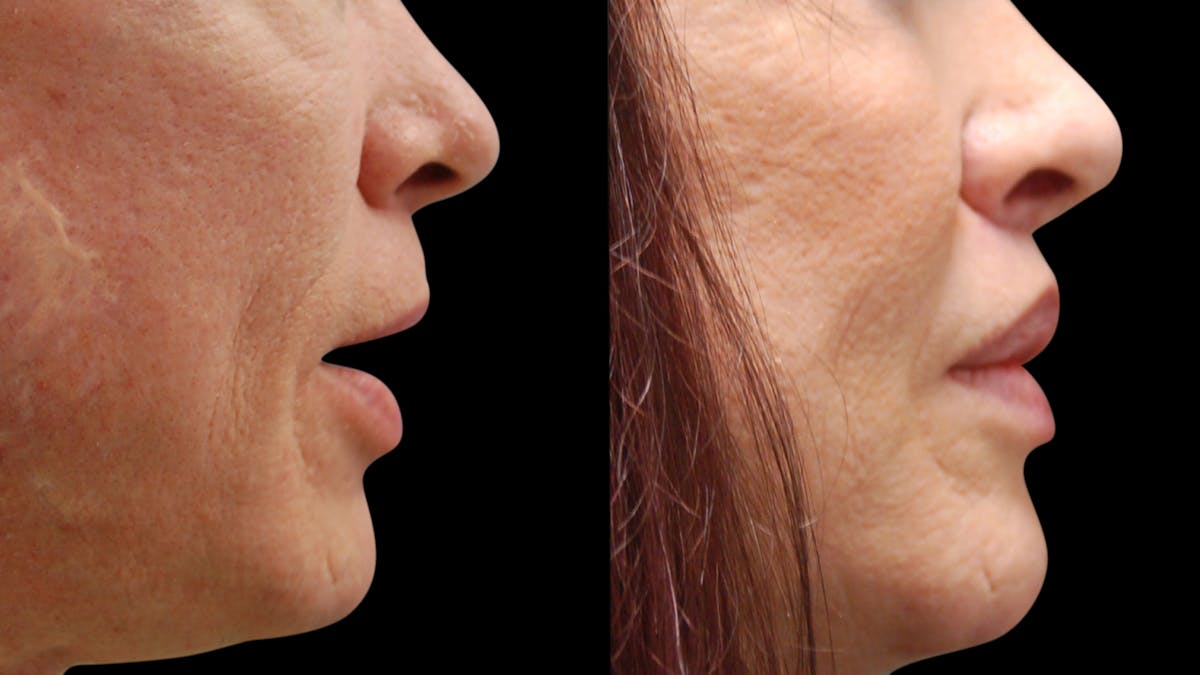 Lip Lift Before & After Gallery - Patient 544085 - Image 12