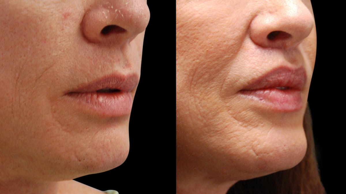 Lip Lift Before & After Gallery - Patient 544085 - Image 13