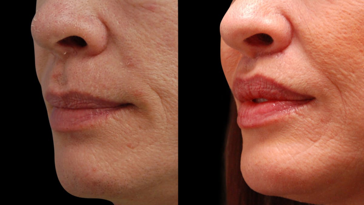 Lip Lift Before & After Gallery - Patient 544085 - Image 1