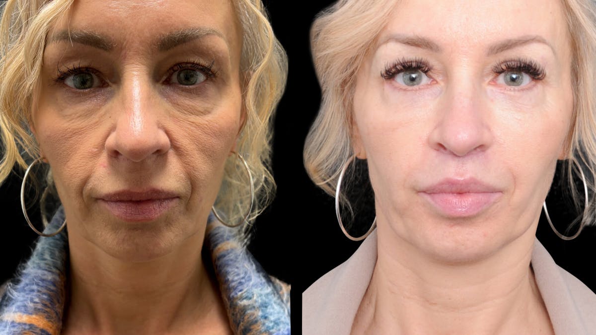 Lip Lift Before & After Gallery - Patient 267046 - Image 4