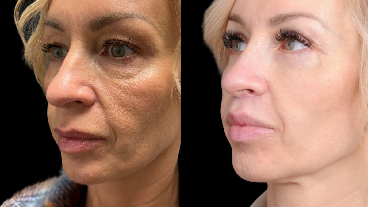 Lip Lift Before & After Gallery - Patient 267046 - Image 1