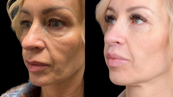 Lip Lift Before & After Gallery - Patient 267046 - Image 1