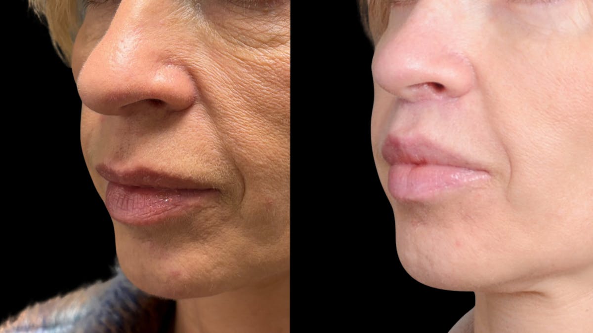 Lip Lift Before & After Gallery - Patient 267046 - Image 2